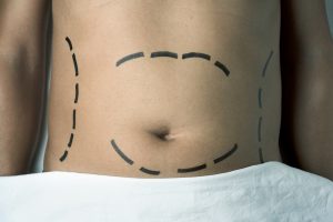 Liposuction Patient Guide