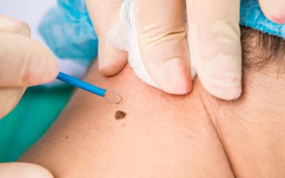 Skin cancer check in Bolton