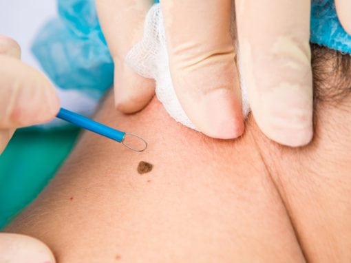 Skin cancer and mole removal