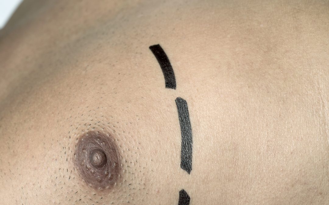 Gynaecomastia Surgery in Liverpool