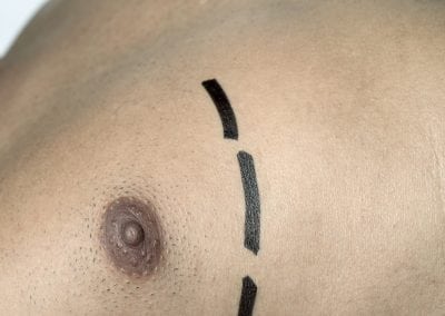 Gynaecomastia surgery (male breast reduction)