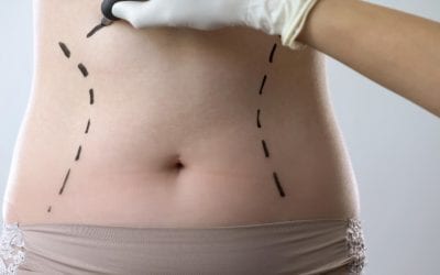 Tummy Tuck Spire Liverpool Hospital